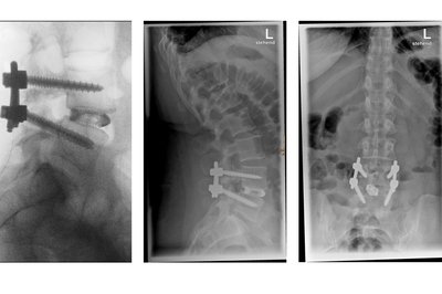 Röntgenbild Repositionsspondylodese