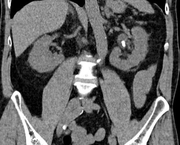 Computertomographie eines Nierenbeckensteins