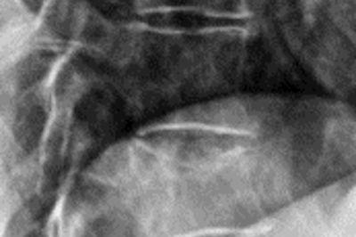 Röntgenbild Wirbelfraktur