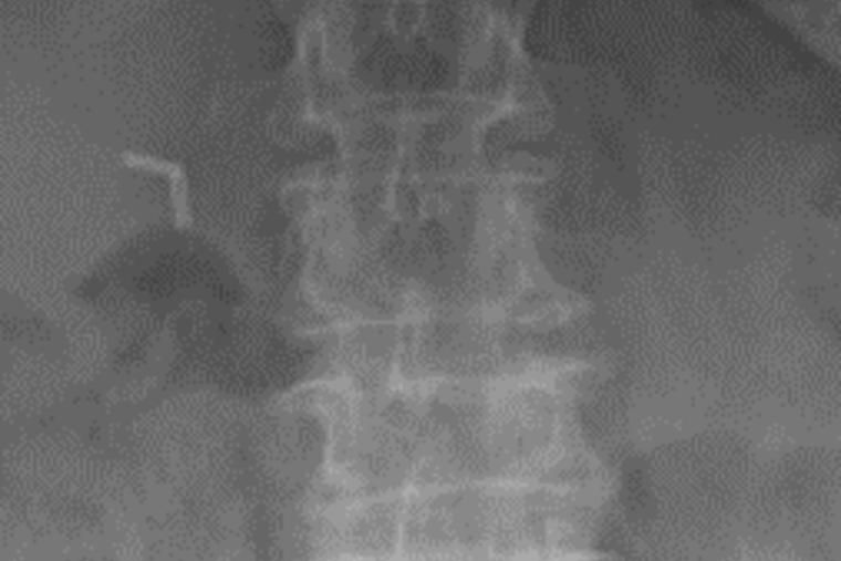 Wirbelbruch bei Osteoporose