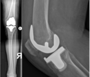 Röntgenbild eines teilzementierten Doppelschlittens am Knie
