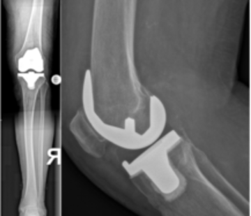 Röntgenbild eines teilzementierten Doppelschlittens am Knie