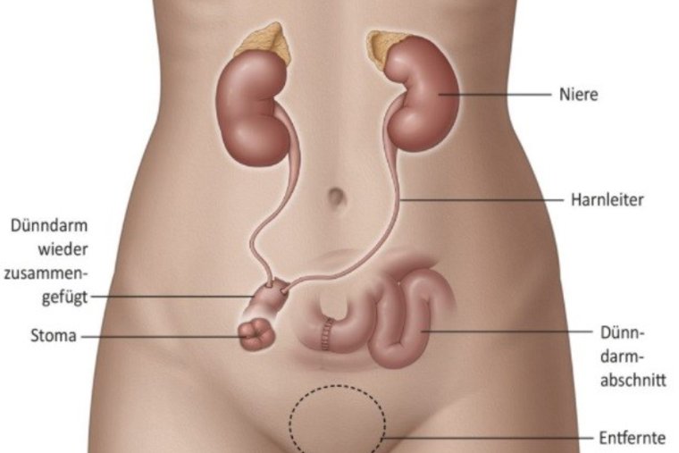 Grafik eines Ileum-Conduit mit künstlicher Bauchdecke