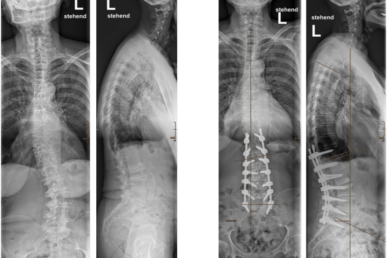 Roentgenbilder Skoliose Loretto-Krankenhaus
