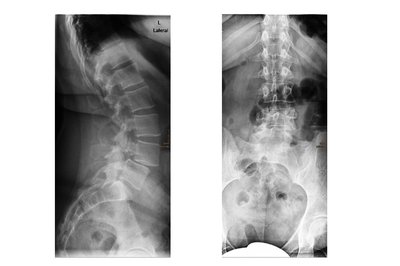 Röntgenbild Wirbelgleiten