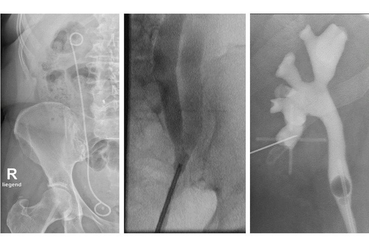 Röntgenbilder von Kathetern und Harnleitern