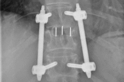 Verschraubter Wirbelbruch