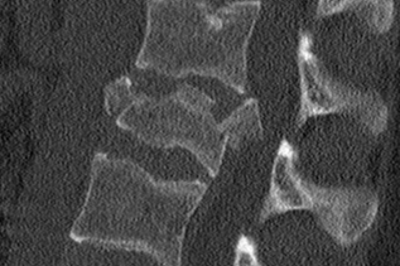 Wirbelbruch mit Spinalkanalstenose