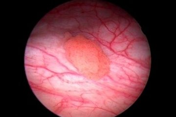 Photodynamische Diagnostik eines Harnblasentumors