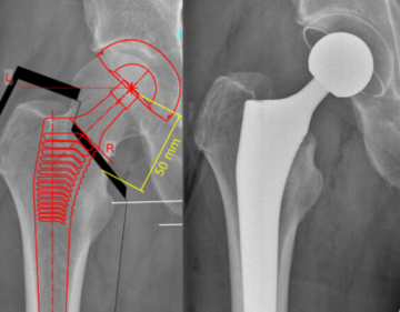 Vorher Nachher Röntgenbilder einer Hüftprothese