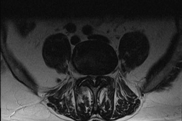 Querschnitt Spinalkanalstenose