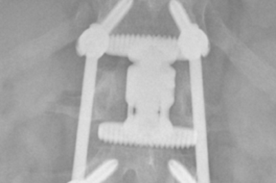 Verschraubte Wirbelfraktur