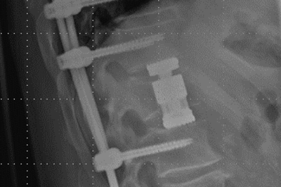 Verschraubter Wirbelbruch