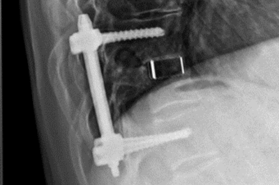 Verschraubter Wirbelbruch