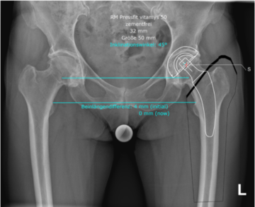 Röntgenbild einer Kurzschaftplanung