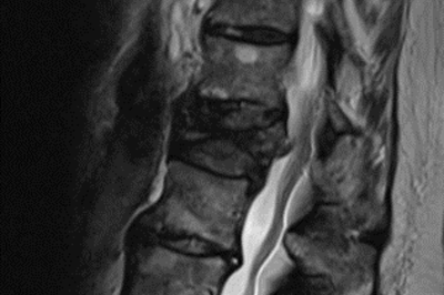 Wirbelsäulenfraktur nach Sturz