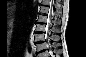 Spinalkanalstenose