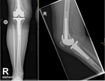 Röntgenbild einer teilgekoppelten Knieprothese 