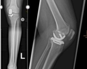 Röntgenbild einer Schlittenprothese