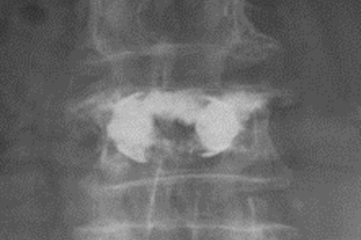 SpineJack-Kyphoplastie